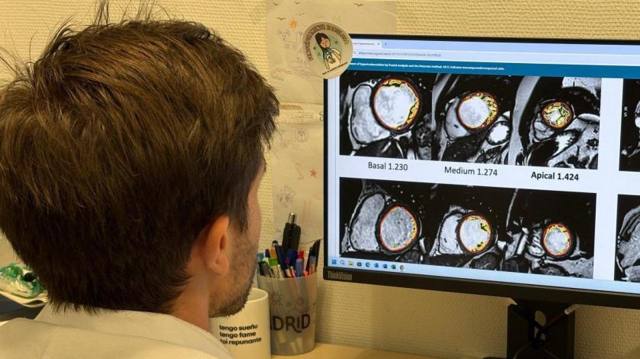 el-puerta-de-hierro-descarta-riesgo-en-un-hallazgo-cardiaco-frecuente